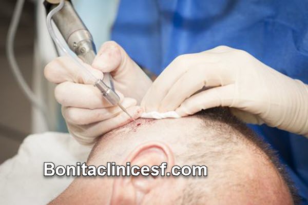 جدیدترین روش کاشت مو چیست؟ | کلینیک بنیتا اصفهان