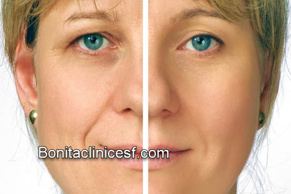 آشنایی با جراحی بلفاروپلاستی پلک بالا با قیمت مناسب در اصفهان