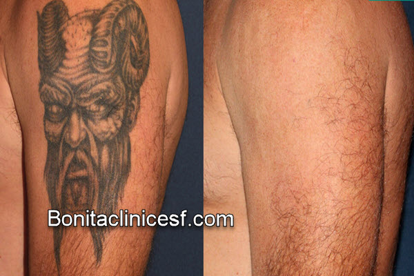 هزینه پاک کردن تاتو با لیزر چقدر است | کلینیک بنیتا اصفهان