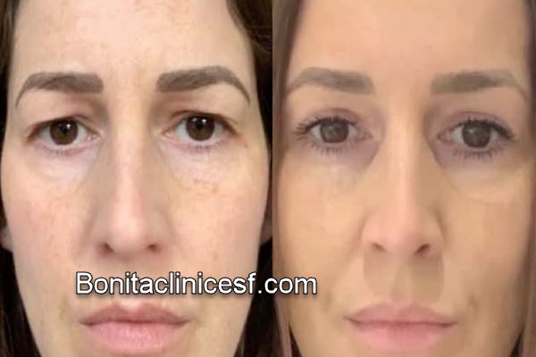 آشنایی با جراحی بلفاروپلاستی پلک بالا با قیمت مناسب در اصفهان