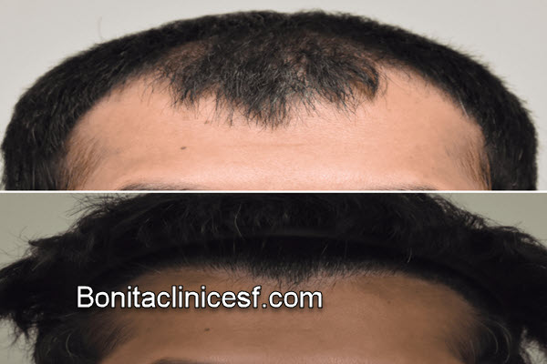 آشنایی با کلینیک تخصصی کاشت موی طبیعی در اصفهان