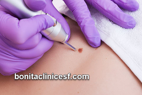 بهترین مرکز برداشتن خال در اصفهان | کلینیک بنیتا اصفهان