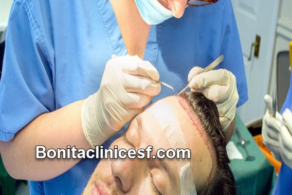 جدیدترین روش کاشت مو چیست؟ | کلینیک بنیتا اصفهان