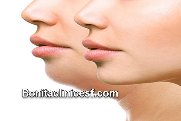 بهترین کلینیک ساکشن غبغب در اصفهان | کلینیک بنیتا اصفهان