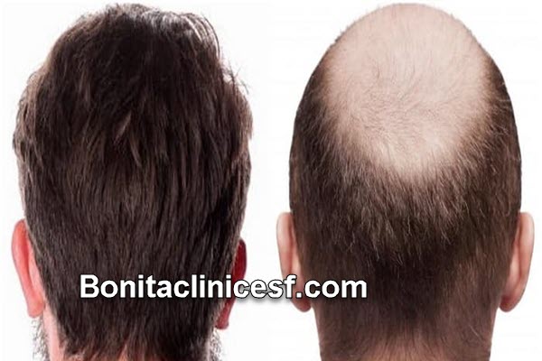 جدیدترین روش کاشت مو چیست؟ | کلینیک بنیتا اصفهان