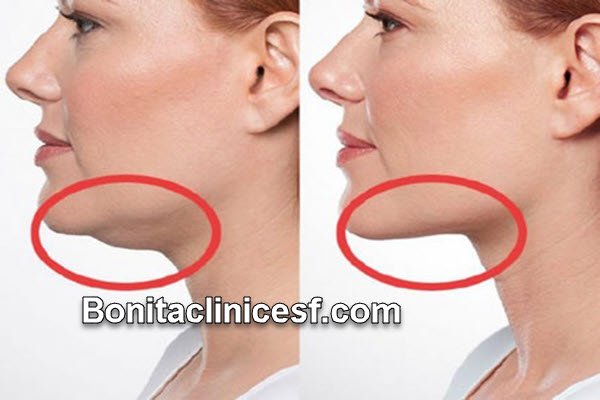 بهترین کلینیک ساکشن غبغب در اصفهان | کلینیک بنیتا اصفهان