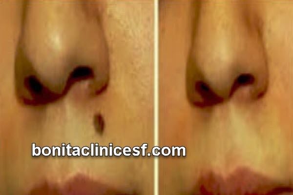 بهترین مرکز برداشتن خال در اصفهان | کلینیک بنیتا اصفهان