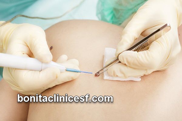 بهترین مرکز برداشتن خال در اصفهان | کلینیک بنیتا اصفهان