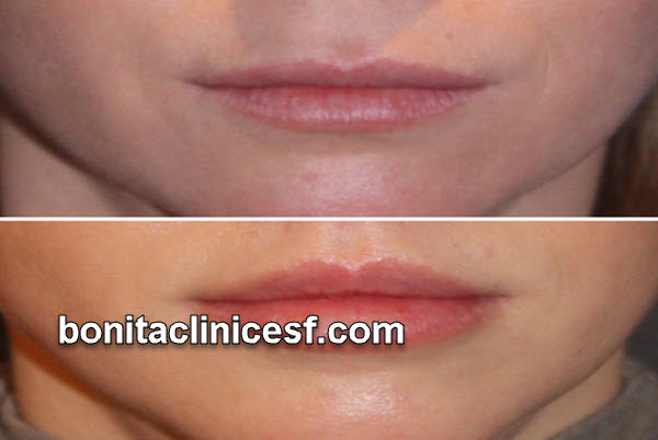 دکتر خوب برای لیفت سانترال لب در اصفهان | کلینیک بنیتا اصفهان