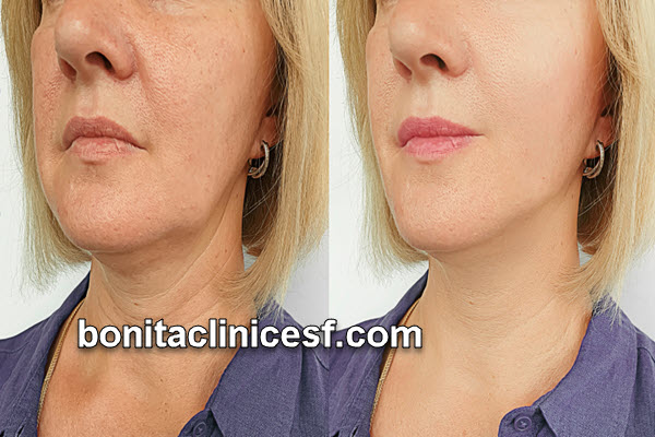 هزینه لیفت صورت با نخ در اصفهان | کلینیک بنیتا اصفهان