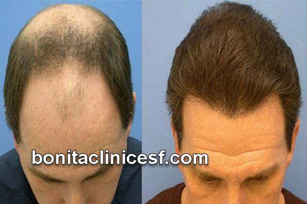 ماندگاری مزوتراپی مو چقدر است؟ | کلینیک بنیتا اصفهان