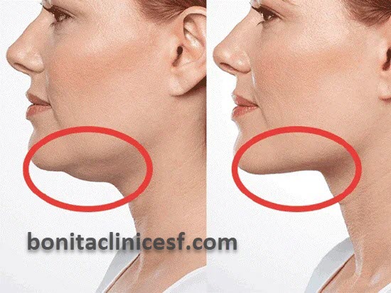 عوامل ژنتیکی موثر در ایجاد غبغب | کلینیک بنیتا اصفهان