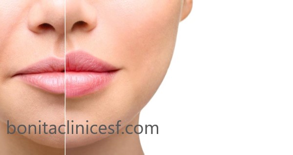 تزریق ژل برای برجسته کردن لب در بهترین مرکز تزریق ژل لب در اصفهان | کلینیک بنیتا