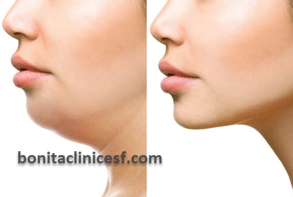 کاربرد جراحی لیپوفیس | کلینیک بنیتا اصفهان