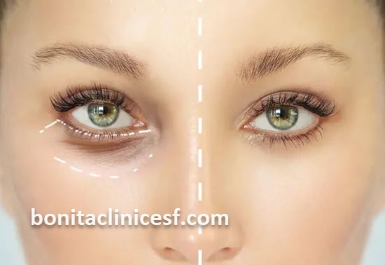 دکتر خوب برای عمل بلفاروپلاستی در اصفهان | کلینیک بنیتا