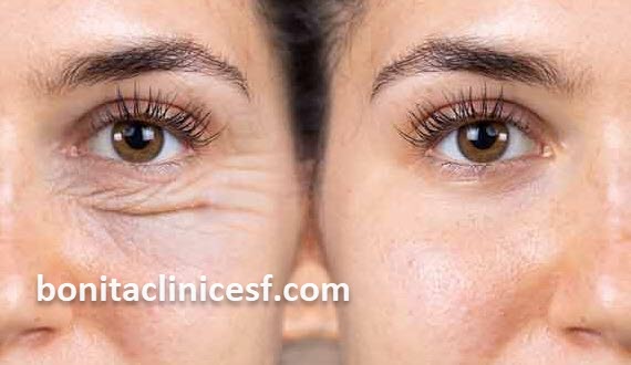 انجام بلفاروپلاستی پلک | کلینیک بنیتا اصفهان