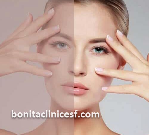 بررسی عوامل موثر در هزینه اندولیفت | کلینیک بنیتا