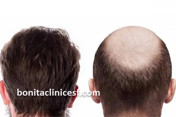 هزینه کاشت مو با تراکم بالا در اصفهان | کلینیک بنیتا