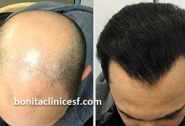 هزینه کاشت مو با تراکم بالا در اصفهان | کلینیک بنیتا