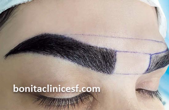 کاشت ابرو طبیعی در اصفهان با قیمت مناسب | کلینیک بنیتا اصفهان