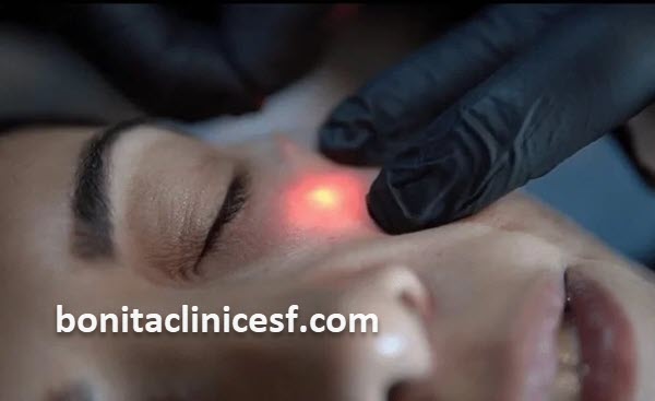 کلینیک تخصصی لیفت صورت با لیزر اندولیفت در اصفهان | کلینیک بنیتا اصفهان