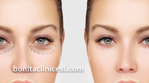 دکتر خوب برای عمل بلفاروپلاستی در اصفهان | کلینیک بنیتا