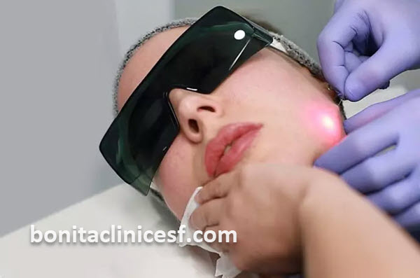 هزینه اندولیفت صورت در اصفهان چقدر است؟ | کلینیک بنیتا اصفهان