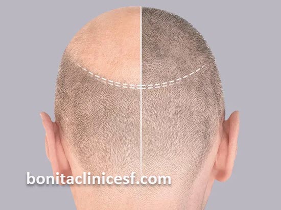 هزینه کاشت مو با تراکم بالا در اصفهان | کلینیک بنیتا