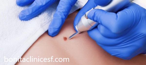 مزایای برداشت خال در کلینیک بنیتا اصفهان