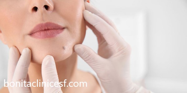 قیمت برداشتن خال در اصفهان | کلینیک بنیتا اصفهان