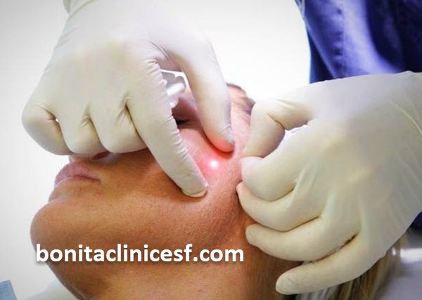 مزایای استفاده از اندولیفت | کلینیک بنیتا اصفهان