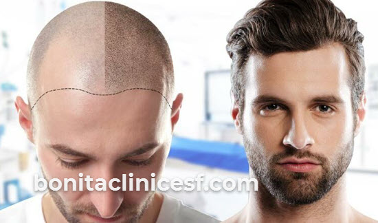 مراقبت هایی که باید بعد از کاشت مو رعایت کنید | کلینیک بنیتا اصفهان