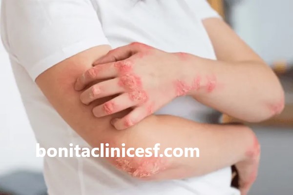 دکتر خوب برای درمان بیماری پسوریازیس در اصفهان | کلینیک بنیتا