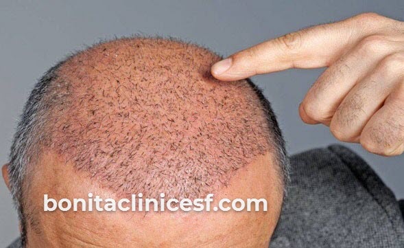 آشنایی با مراقبت های بعد از کاشت مو | کلینیک بنیتا اصفهان