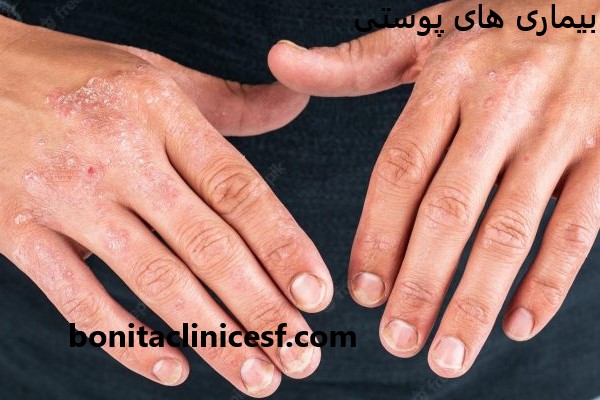 درمان انواع بیماری های پوستی | کلینیک بنیتا اصفهان