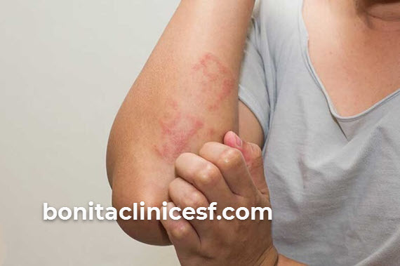 متخصص درمان بیماری های قارچی پوست در اصفهان | کلینیک بنیتا اصفهان