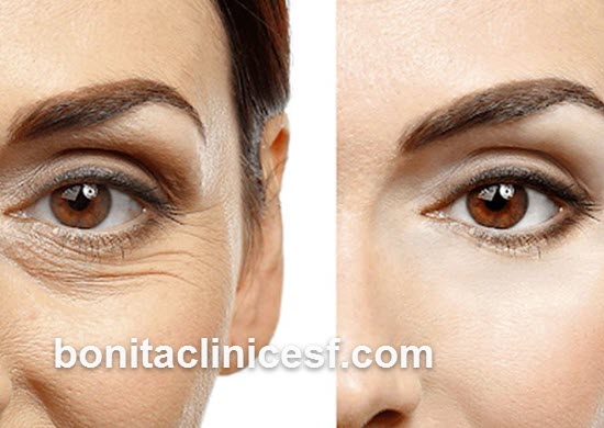 عوامل مؤثر بر قیمت بلفاروپلاستی پلک بالا | کلینیک بنیتا اصفهان