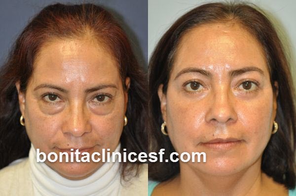 انواع جراحی بلفاروپلاستی یا افتادگی پلک | کلینیک بنیتا اصفهان