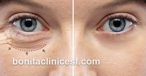 هزینه جراحی بلفارو | کلینیک بنیتا اصفهان