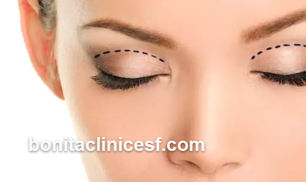 قیمت بلفاروپلاستی پلک بالا در اصفهان چقدر است؟ | کلینیک بنیتا اصفهان