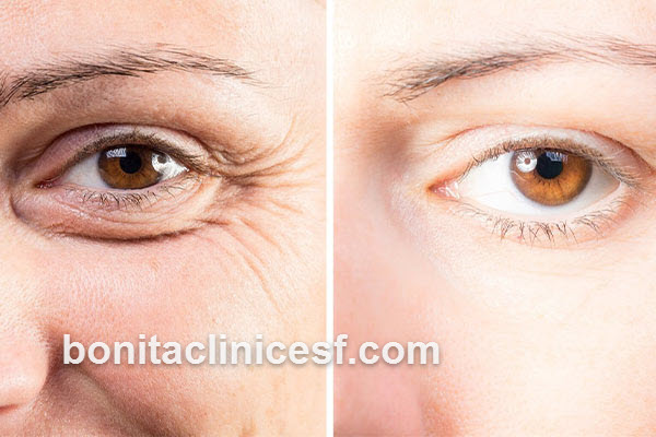 پزشک متخصص جراحی بلفاروپلاستی در شهر اصفهان | کلینیک بنیتا اصفهان