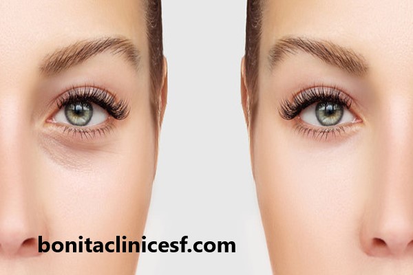 بلفاروپلاستی پلک پایین در اصفهان | کلینیک بنیتا اصفهان