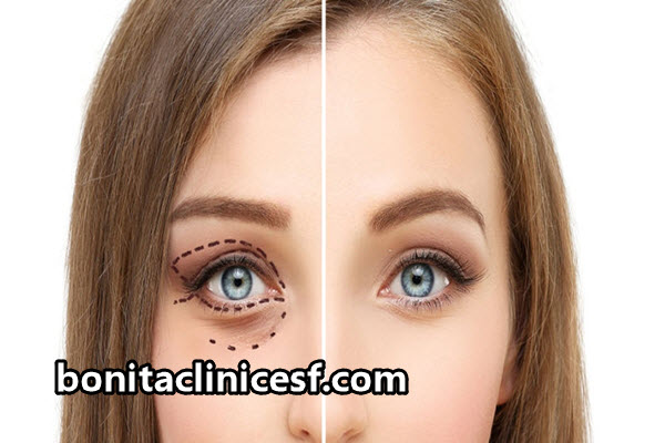 جراحی پلک با لیزر در اصفهان | کلینیک بنیتا اصفهان