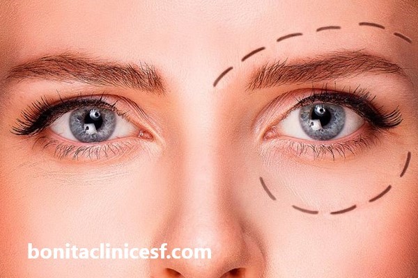 بررسی مراقبت های بعد از عمل بلفاروپلاستی | کلینیک بنیتا اصفهان