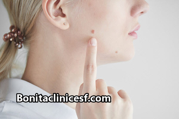 سریعترین راه برای برداشتن خال در اصفهان | کلینیک بنیتا اصفهان