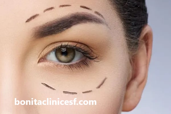 بلفاروپلاستی پلک پایین | کلینیک بنیتا اصفهان