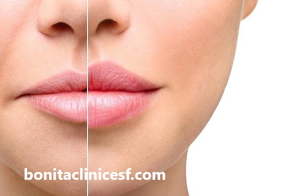 بهترین مرکز تزریق فیلر در اصفهان | کلینیک بنیتا اصفهان