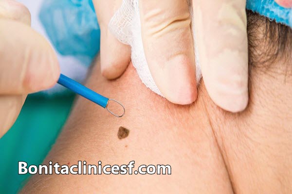 سریع ترین راه برداشتن خال در اصفهان - کلینیک بنیتا اصفهان