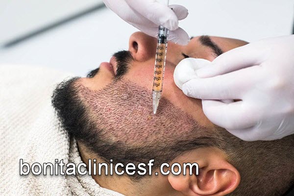 کاشت ریش توسط بهترین متخصصان | کلینیک بنیتا اصفهان
