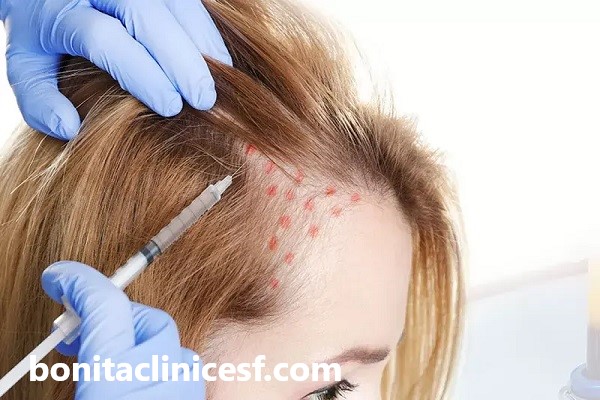 پی آر پی مو در بهترین کلینیک اصفهان | کلینیک بنیتا اصفهان